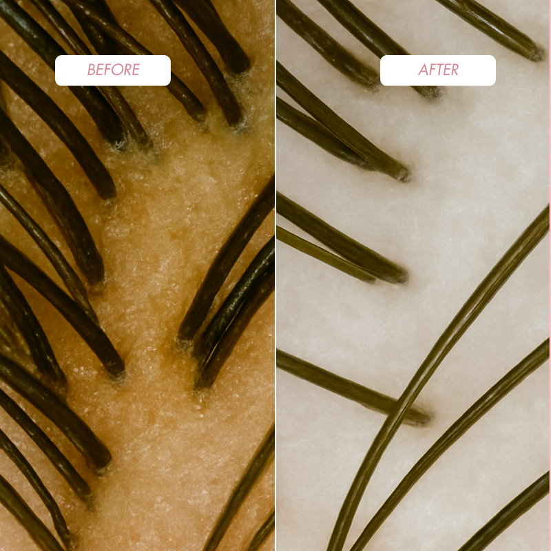 Trío Tricológico ProHair – Champú, Mascarilla y Peeling para el cuero cabelludo y el cabello